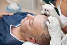 Is Dubai the Best Place for a Hair Transplant in 2025?