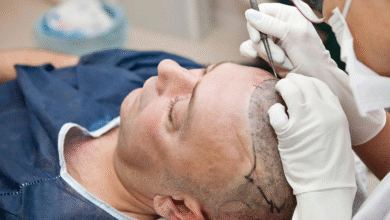 Is Dubai the Best Place for a Hair Transplant in 2025?