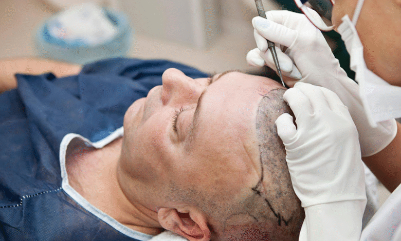 Is Dubai the Best Place for a Hair Transplant in 2025?